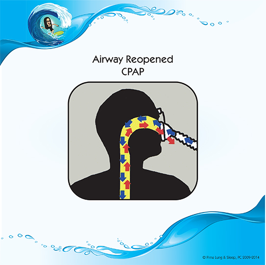 Airway reopened CPAP
